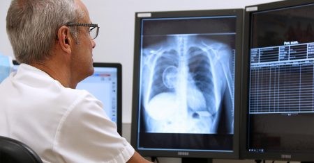 Cáncer de pulmón en radiografías